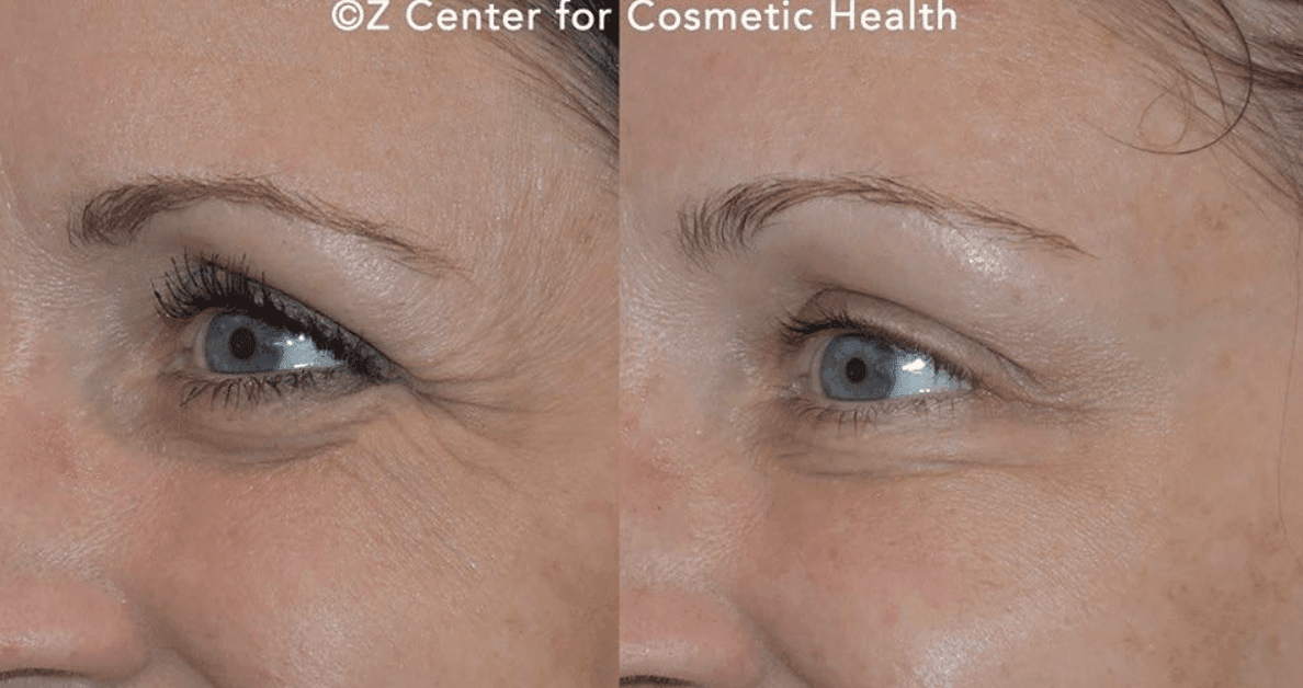 preventative botox