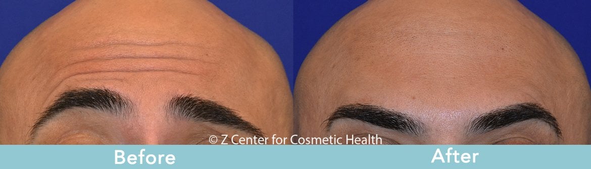 preventative botox