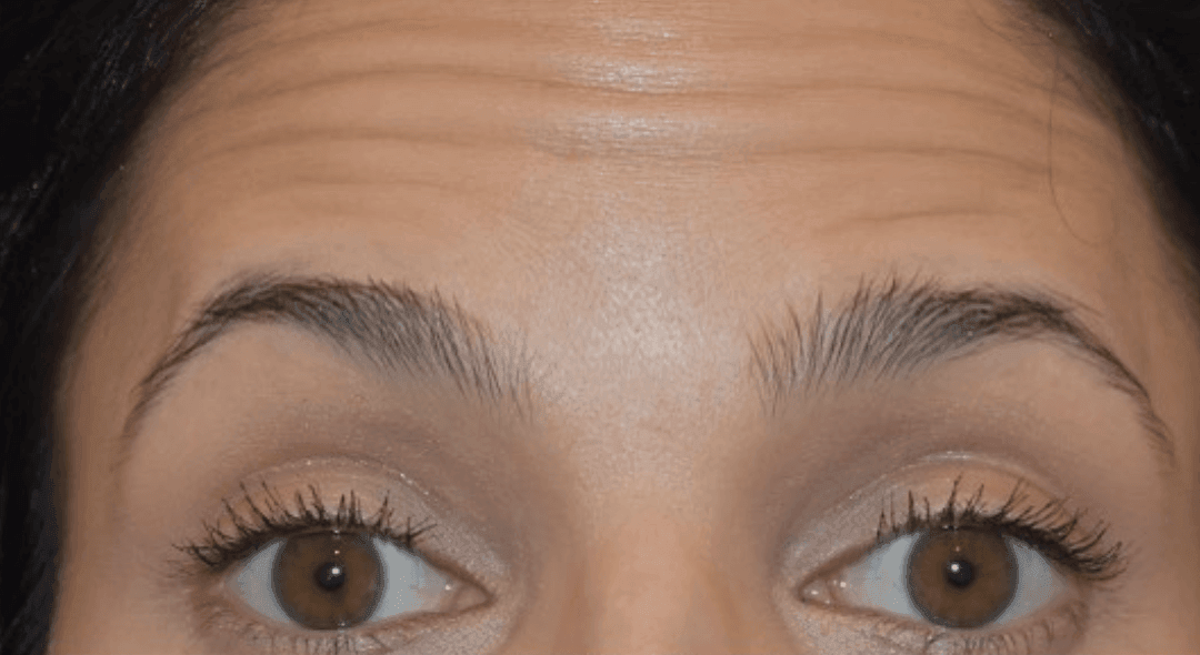 Botox vs. Dysport: Which One Should I Get?