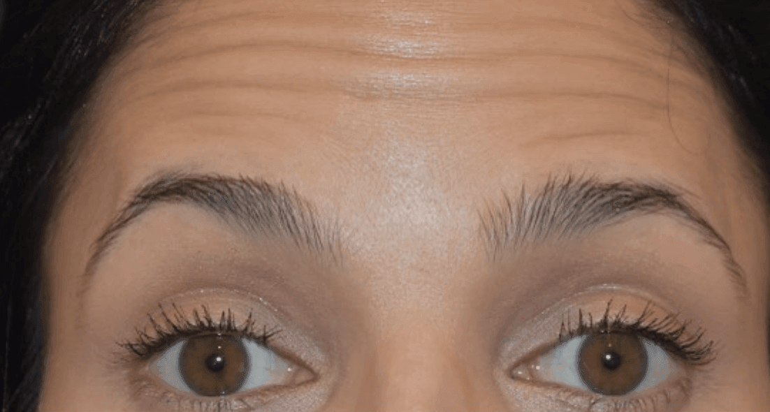 Average-Botox-Units-By-Facial-Part--A-Breakdown