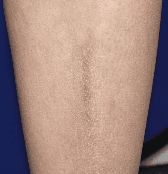 Treat Your Scar With This Laser Treatment