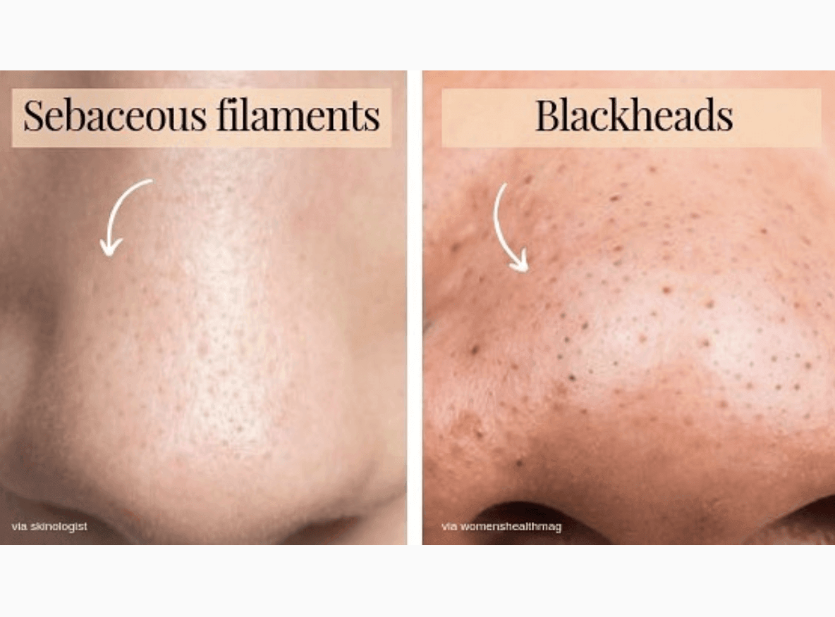 Sebaceous-Filaments-vs--Blackheads