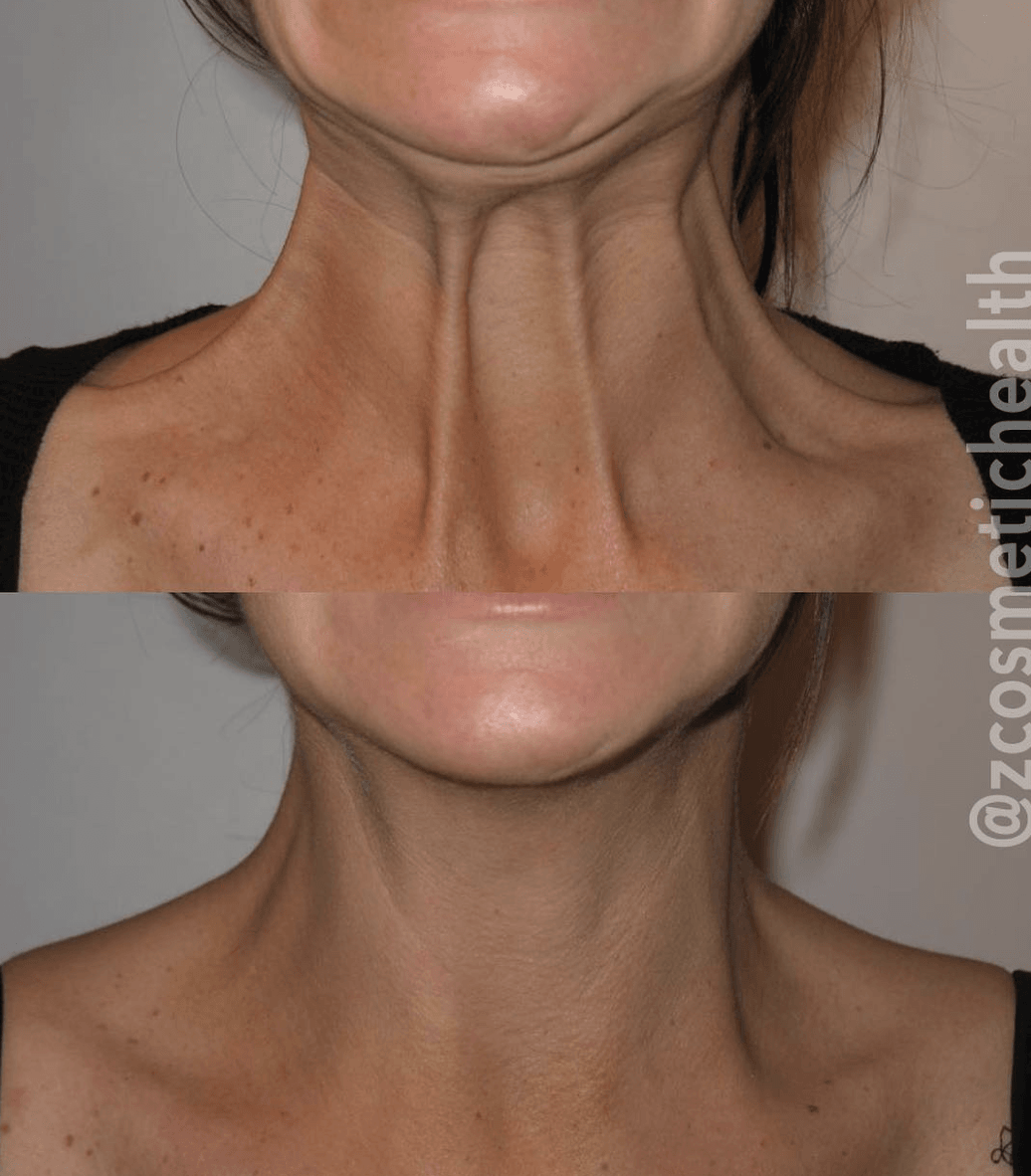neck bands