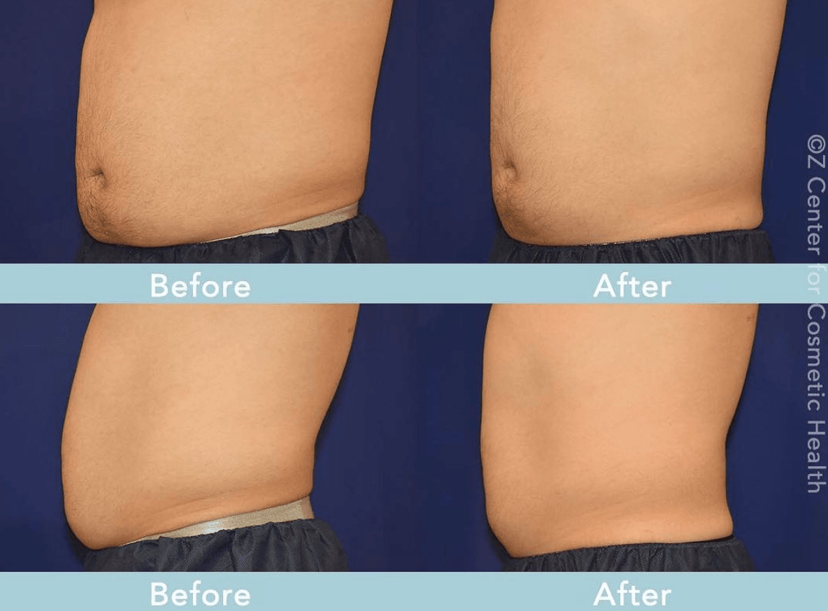 emsculpt