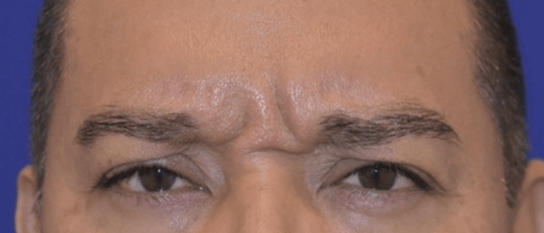 The Top Treatments for Glabellar Lines