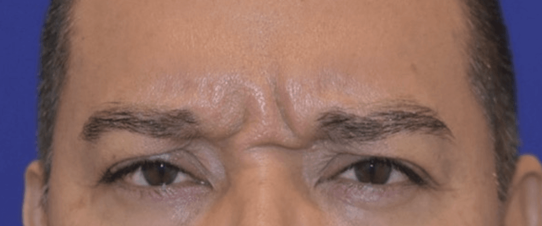 The-Top-Treatments-for-Glabellar-Lines