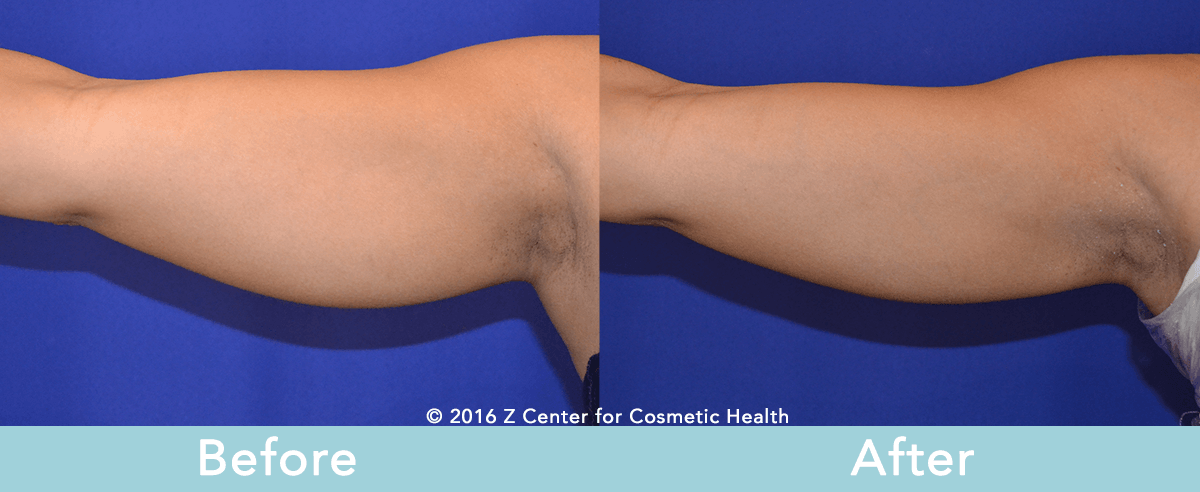 coolsculpting