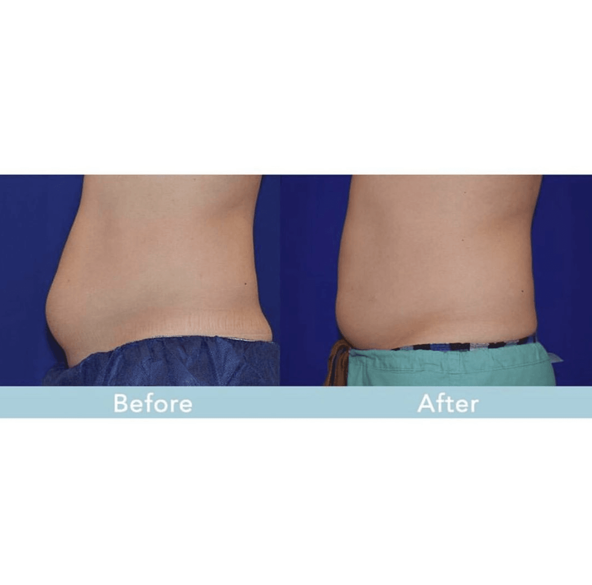 Answering-Your-CoolSculpting-Questions