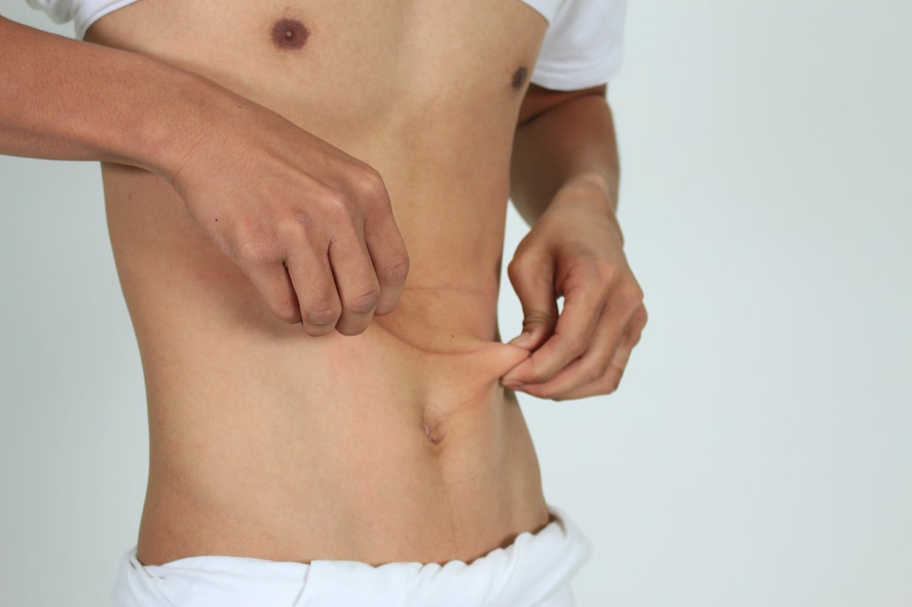 What-Can-Help-With-My-Stretch-Marks--Try-These-Top-Treatments