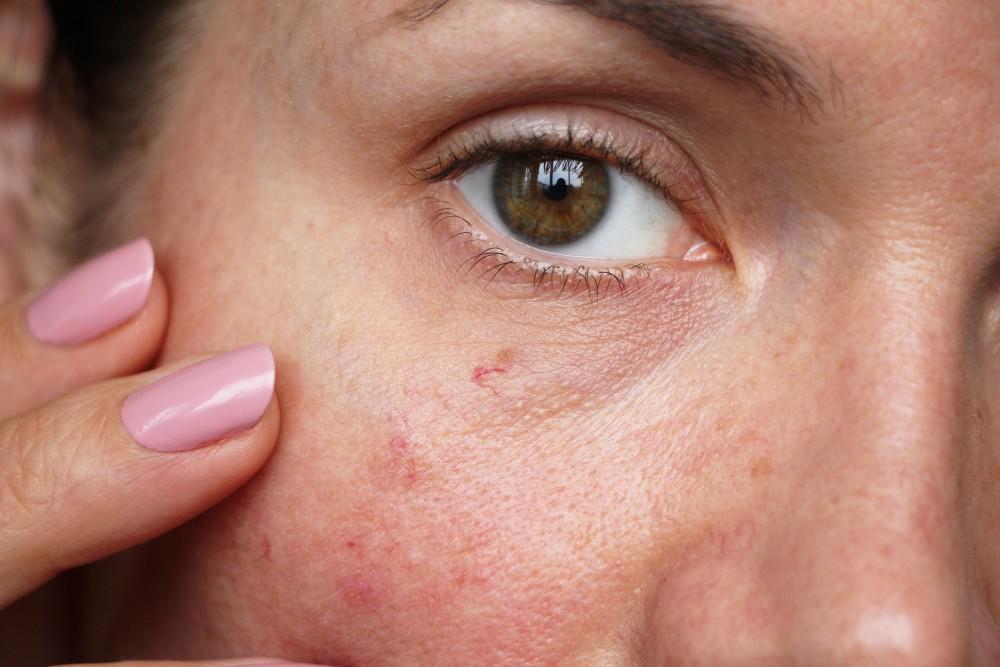 How Do I Treat and Prevent Spider Veins on My Face?