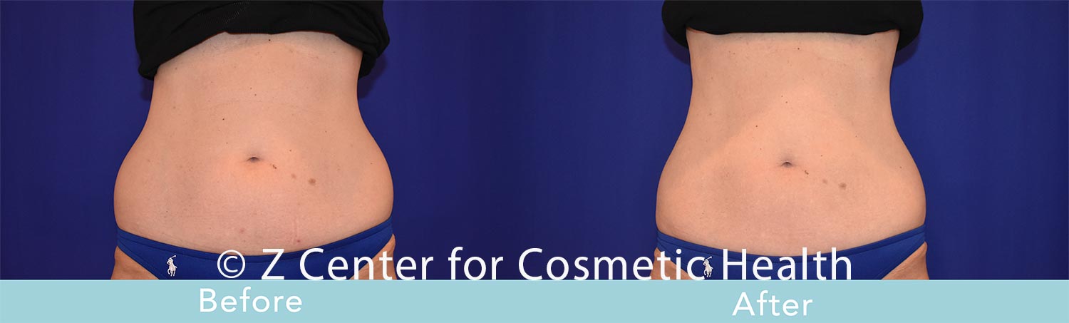 Coolsculpting-Flank-Before---038--After--6