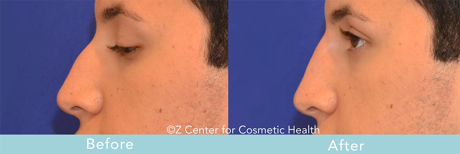non-surgical nose job