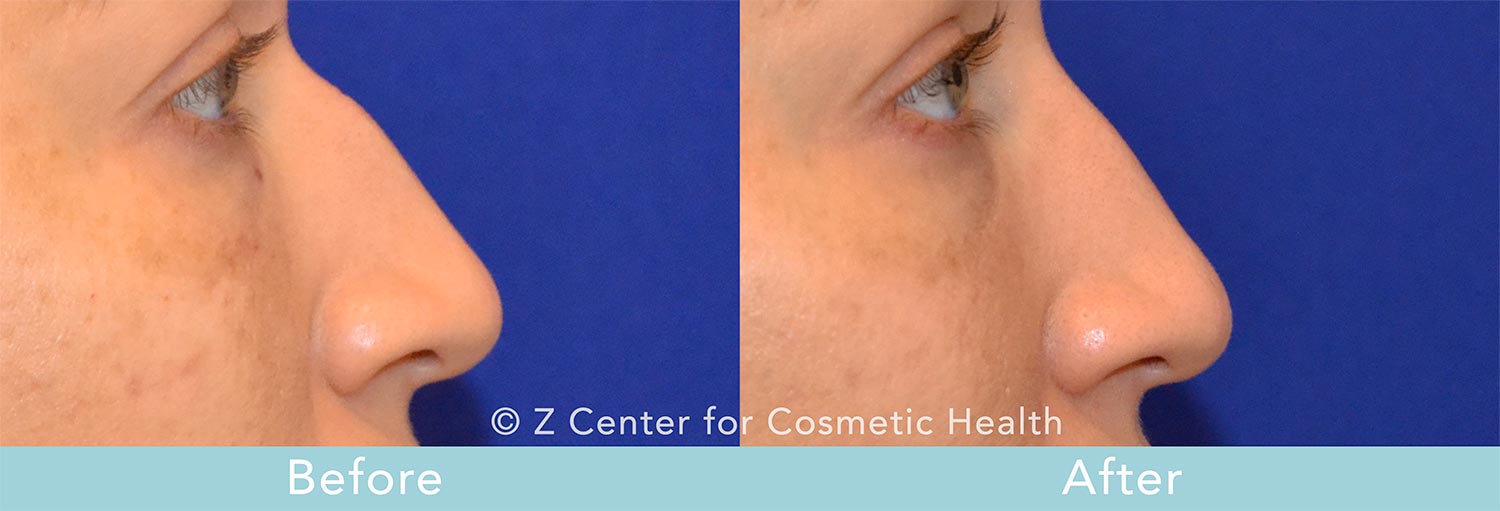 non-surgical nose job