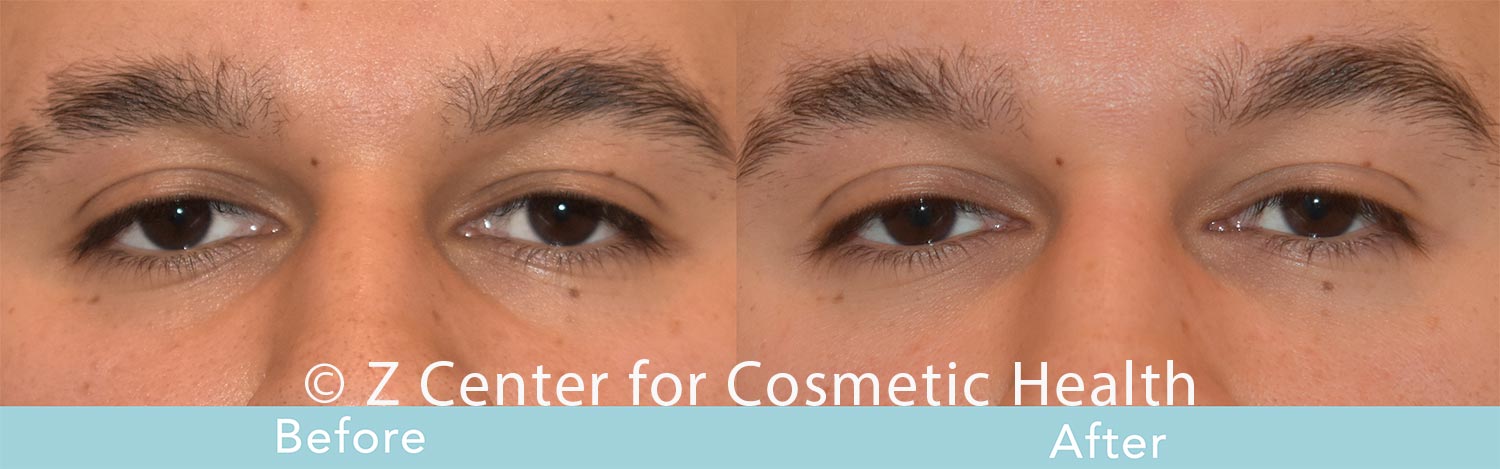 Fillers---8211--Undereyes