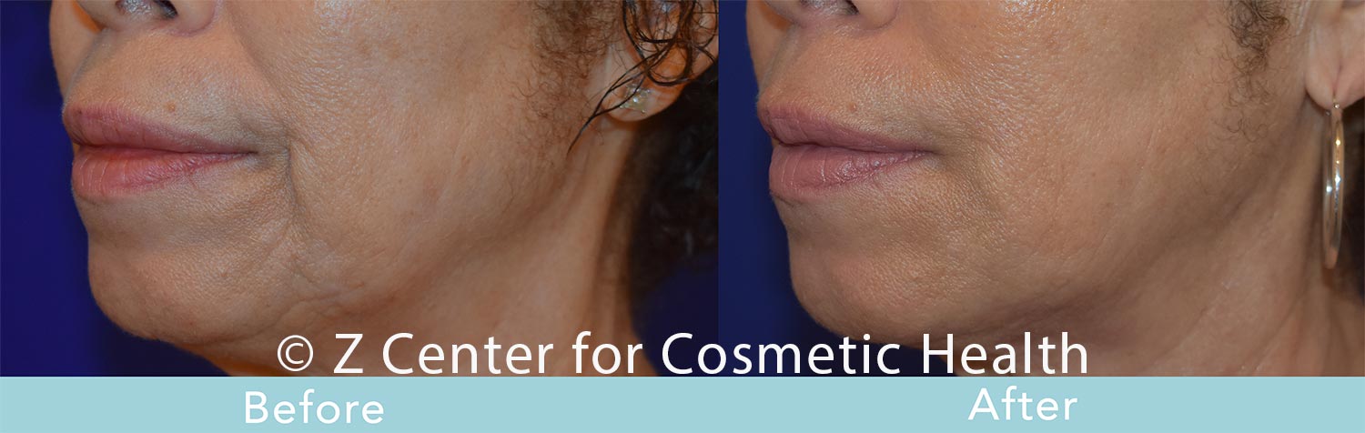Fillers---8211--NLF-Smile-Lines