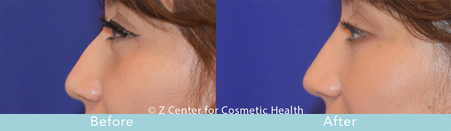 non-surgical nose job
