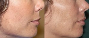 RF Microneedling 