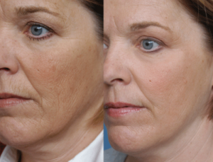 Laser Skin Resurfacing 