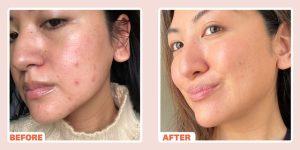 Radiofrequency Microneedling