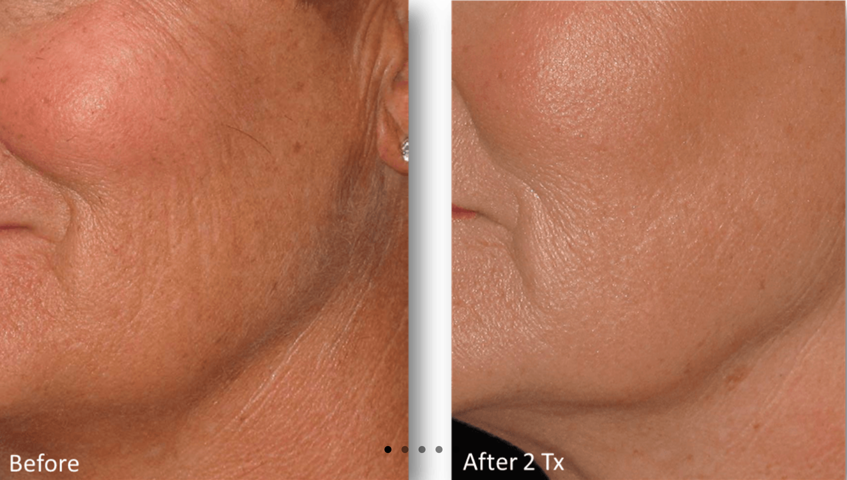 microneedling for acne scars