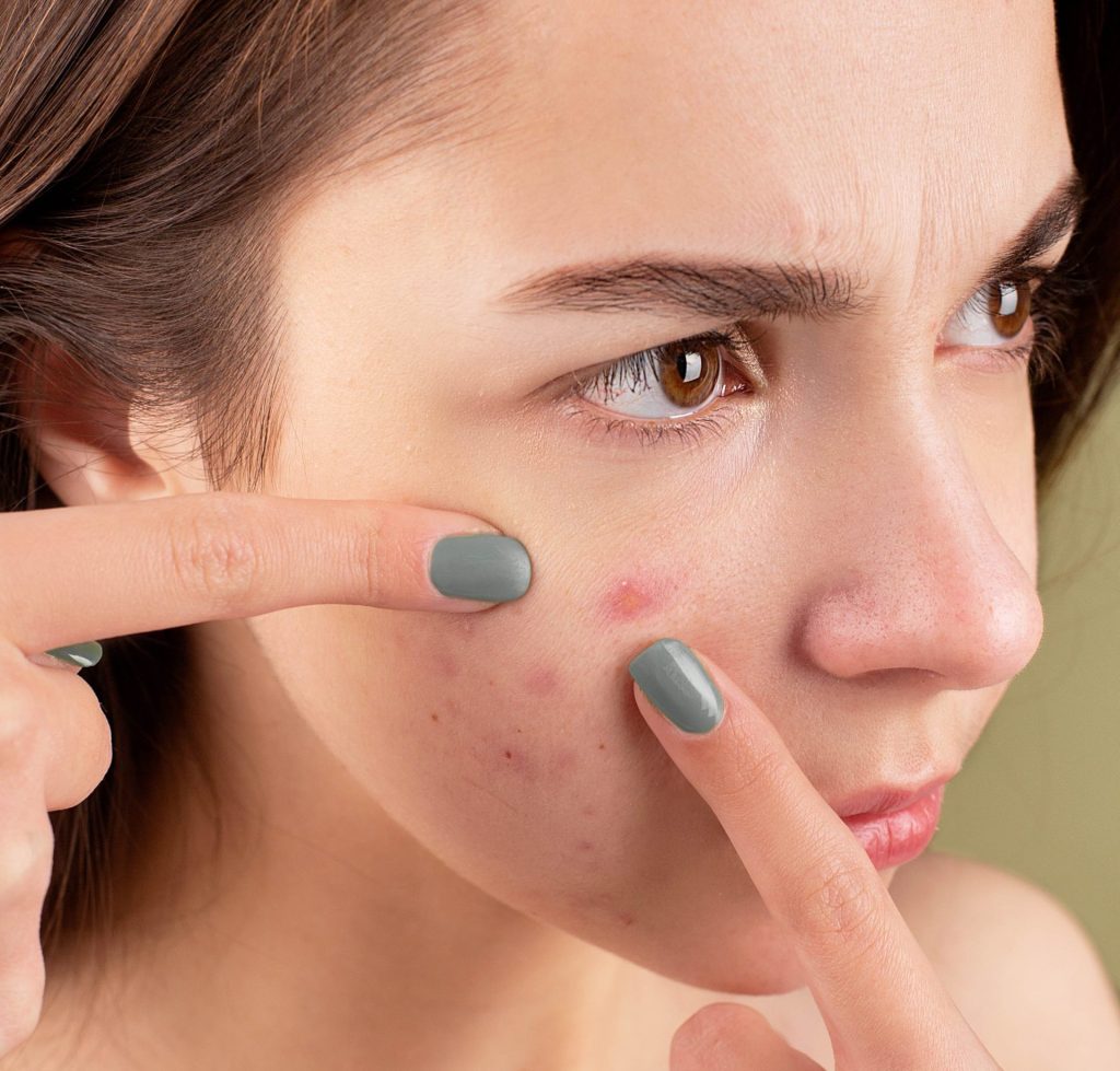 microneedling for acne scars