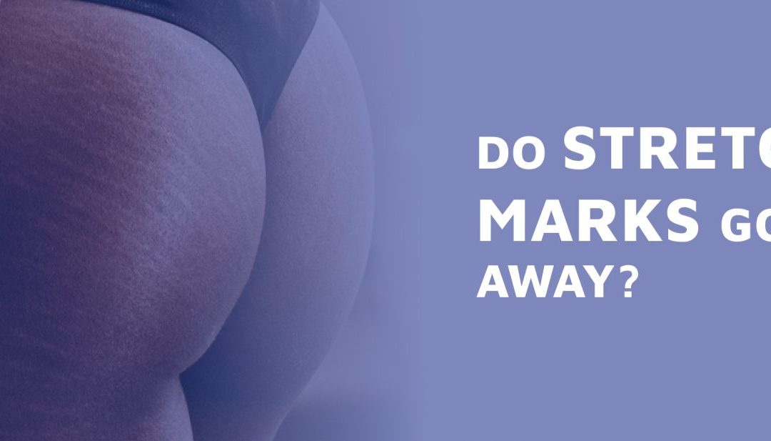 Do Stretch Marks Go Away?