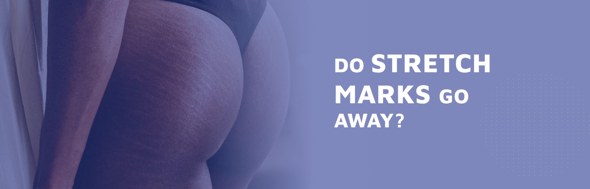 Do-Stretch-Marks-Go-Away-