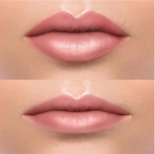 Why-People-Are-Getting-Lip-Fillers-Dissolved