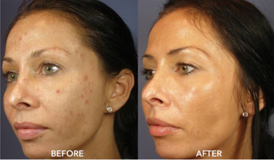 VI-Peel-for-Acne-Scars